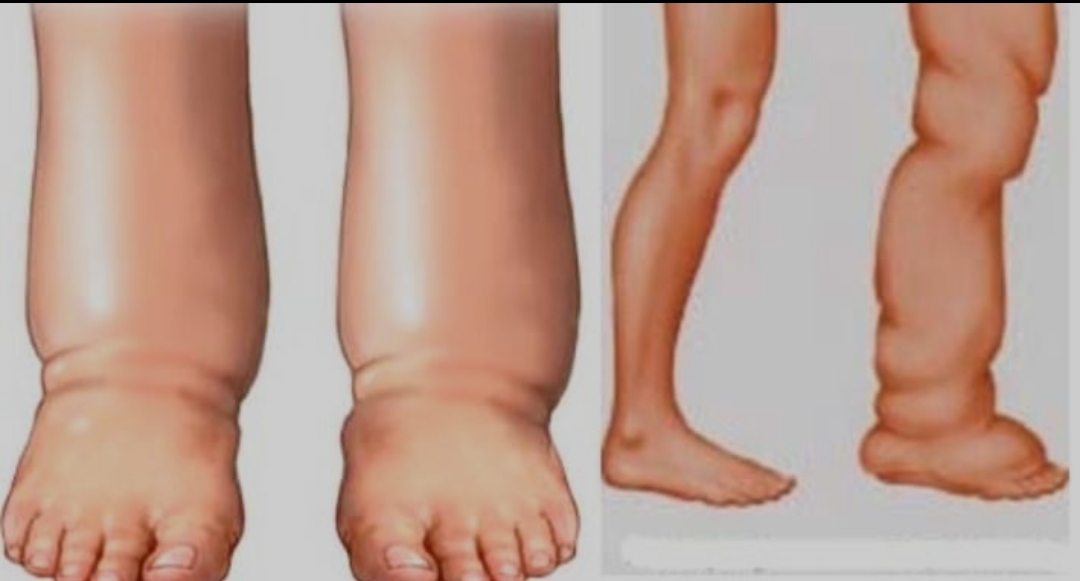 बाँकेमा  सोमबारदेखि हात्तीपाइले रोगविरुद्धको औषधि सेवन शुरू